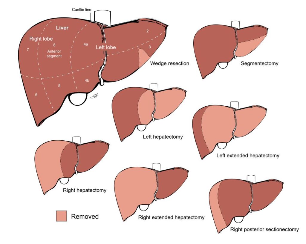 liver-resection