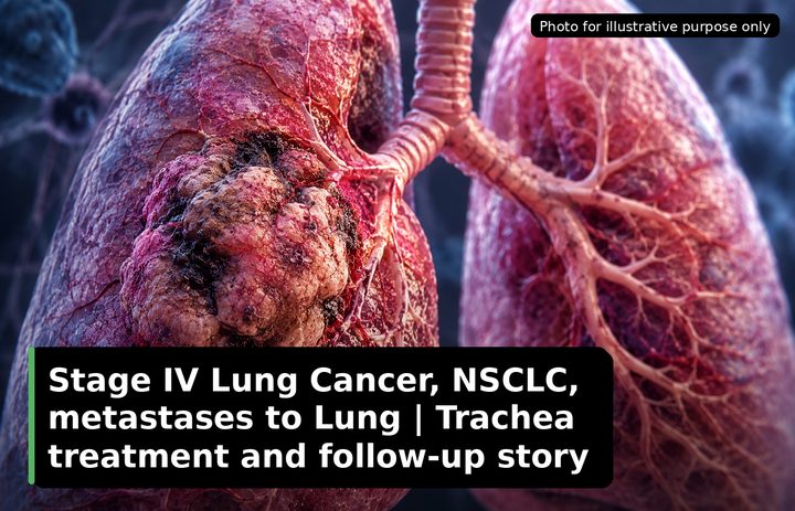 A patient, who was diagnosed with Stage IV Lung Cancer