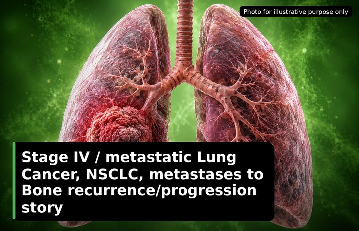 A patient, who was diagnosed with Stage IV Lung Cancer