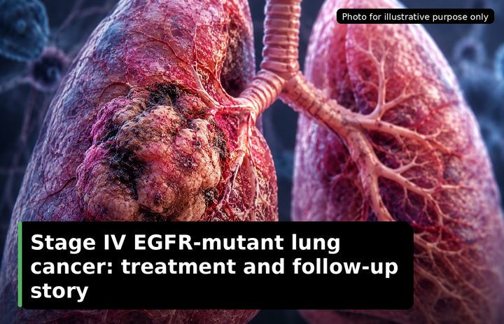 A patient, who was diagnosed with Lung Adenocarcinoma