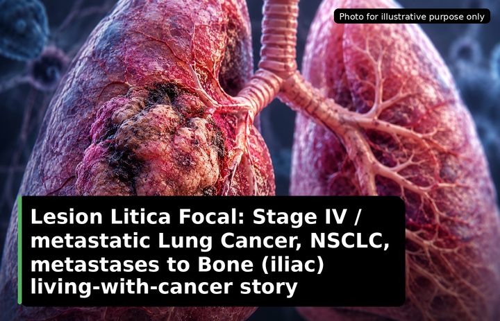 A patient, who was diagnosed with Stage IV Lung Cancer