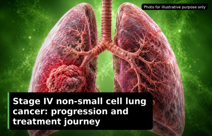 A patient, who was diagnosed with Lung Cancer