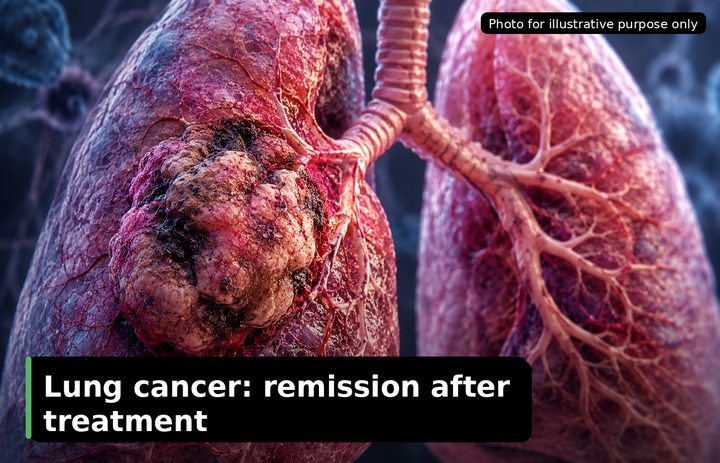 Pascal, who was diagnosed with Lung Cancer