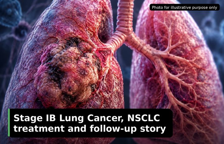 A patient, who was diagnosed with Stage I Lung Cancer