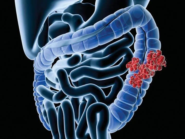 A patient, who was diagnosed with Colorectal Cancer