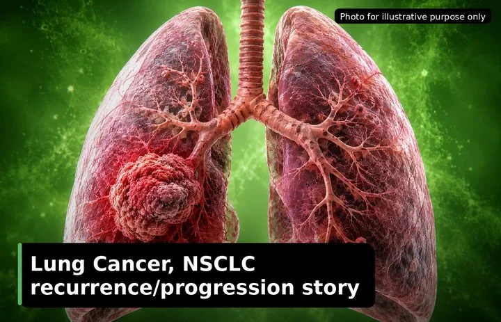 A patient, who was diagnosed with Lung Cancer