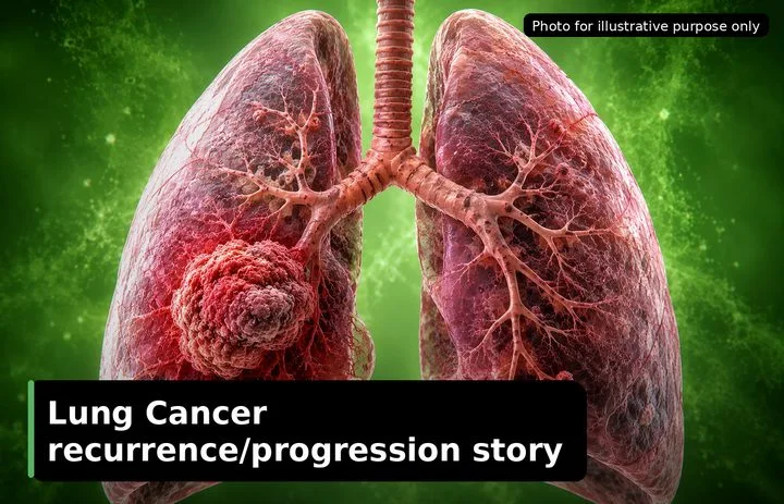 A patient, who was diagnosed with Lung Cancer