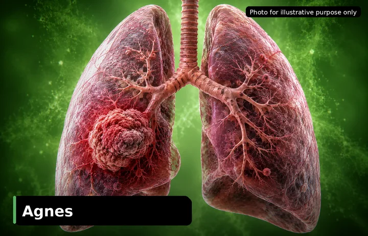 Agnès, who was diagnosed with Stage IV Lung Cancer