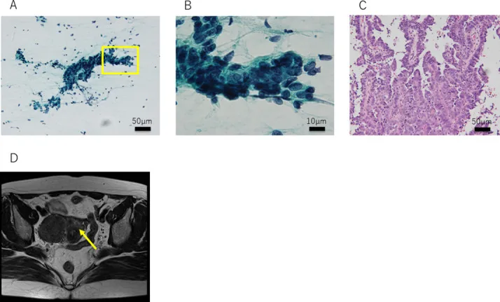 A patient, who was diagnosed with Stage III Ovarian Cancer