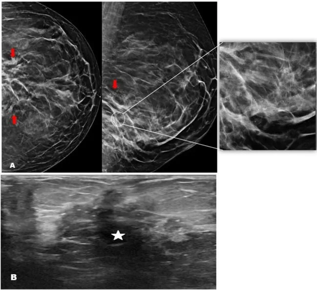 A patient, who was diagnosed with Stage IV Invasive Lobular Carcinoma