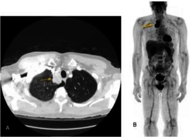 A patient, who was diagnosed with Small Cell Lung Cancer