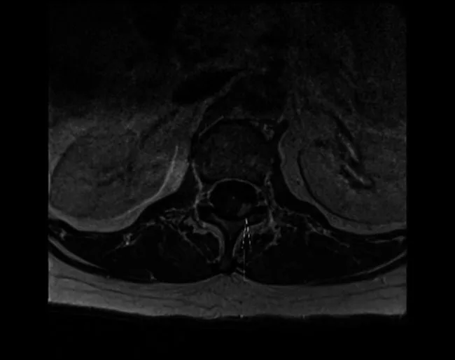 A patient, who was diagnosed with Stage IV Invasive Ductal Carcinoma