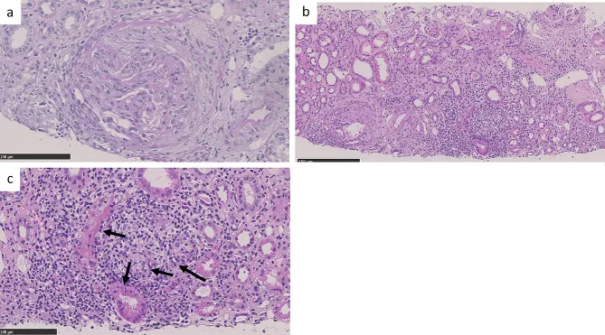 A patient, who was diagnosed with Stage IV Lung Adenocarcinoma