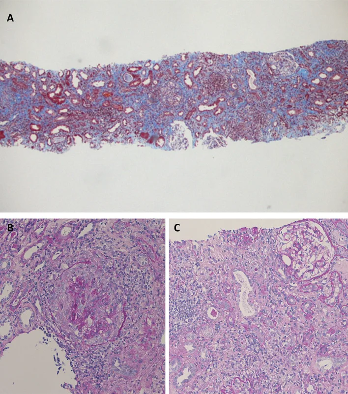 A patient, who was diagnosed with Lung Adenocarcinoma