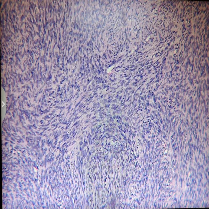 A patient, who was diagnosed with Breast Cancer