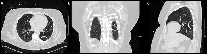 A patient, who was diagnosed with Stage I Lung Cancer