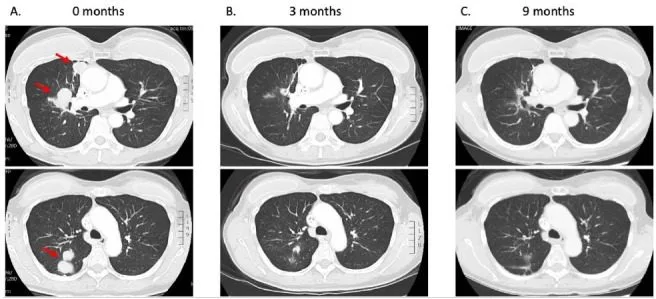 A patient, who was diagnosed with Stage IV Non-Small Cell Lung Cancer