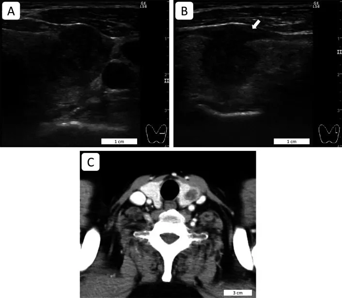 A patient, who was diagnosed with Stage IV Lung Adenocarcinoma
