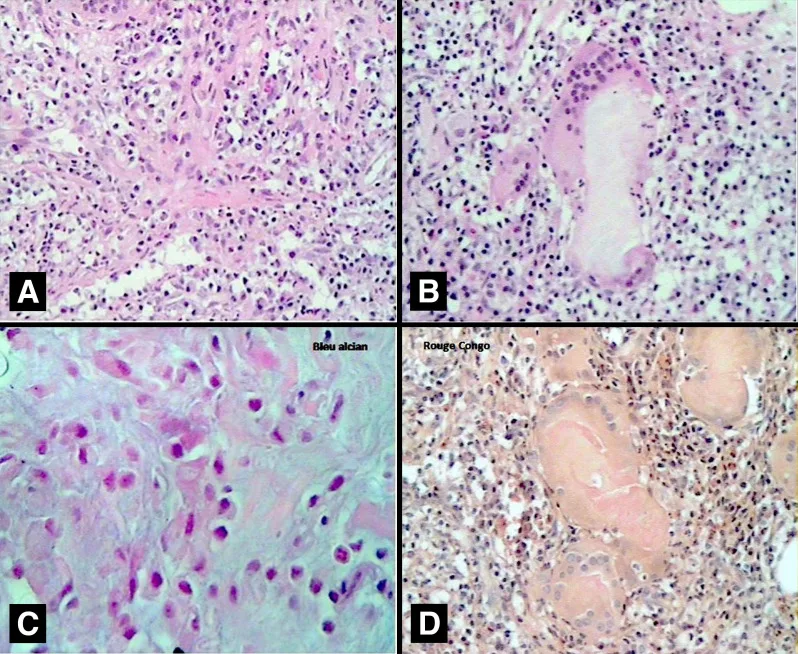 A patient, who was diagnosed with Gastric Adenocarcinoma