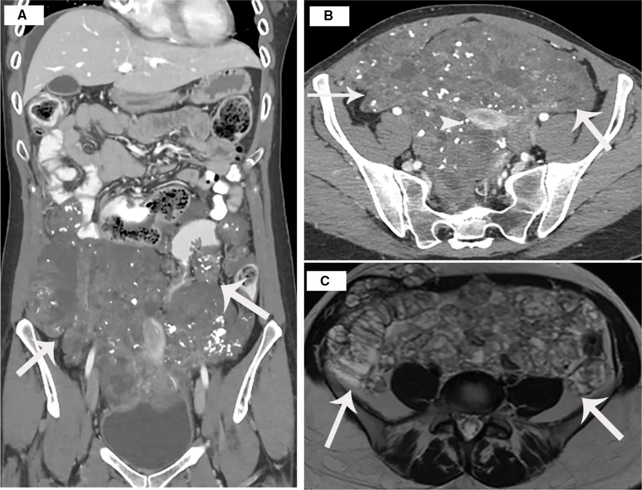 A patient, who was diagnosed with Ovarian Cancer