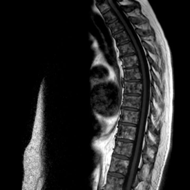 A patient, who was diagnosed with Stage IV Breast Cancer