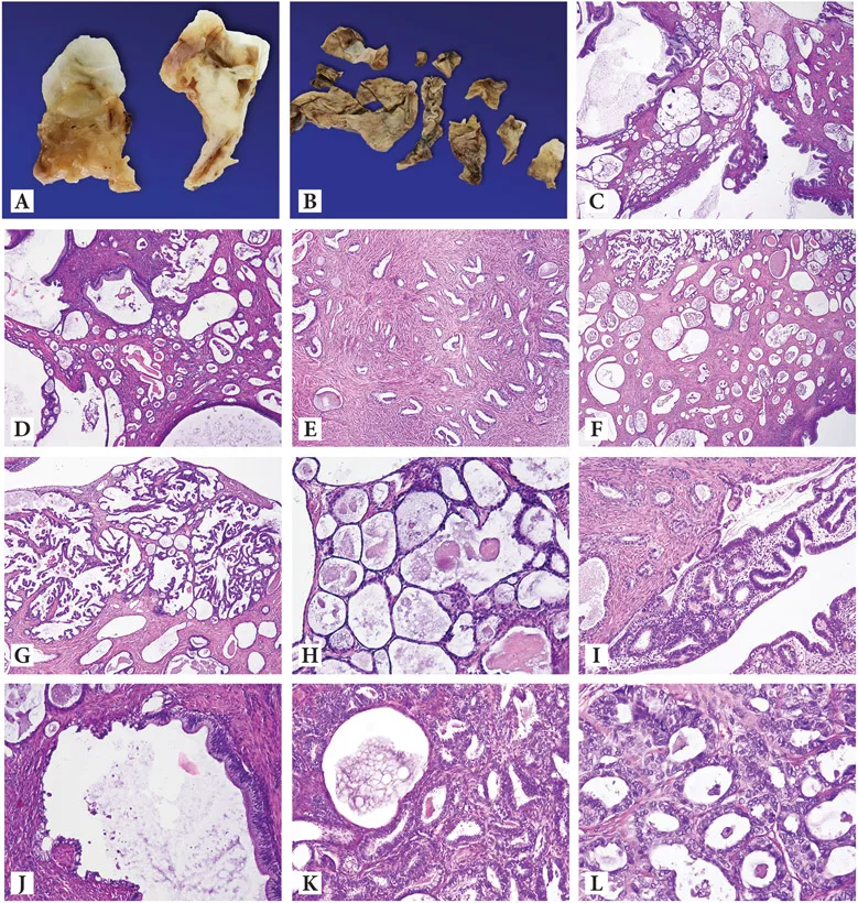 A patient, who was diagnosed with Stage I Ovarian Adenocarcinoma
