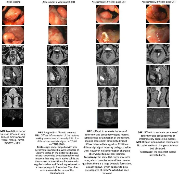A patient, who was diagnosed with Colorectal Adenocarcinoma