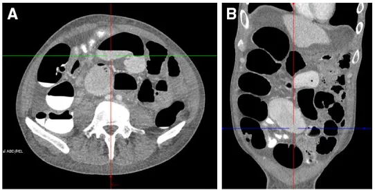 A patient, who was diagnosed with Stage IV Gastric Adenocarcinoma