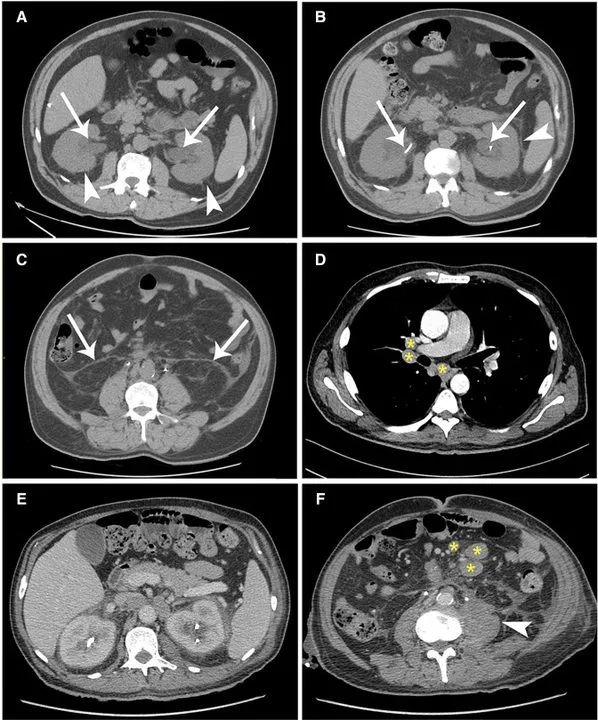 A patient, who was diagnosed with Stage IV Colorectal Adenocarcinoma