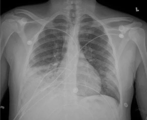 A patient, who was diagnosed with Stage III Lung Adenocarcinoma