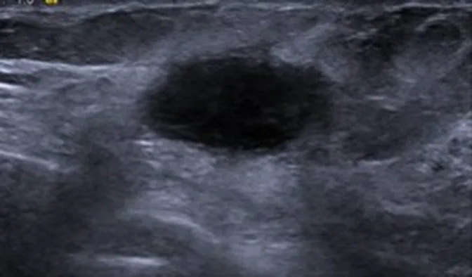 A patient, who was diagnosed with Invasive Ductal Carcinoma