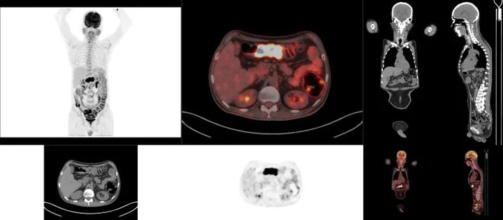 A patient, who was diagnosed with Stage II Colorectal Adenocarcinoma