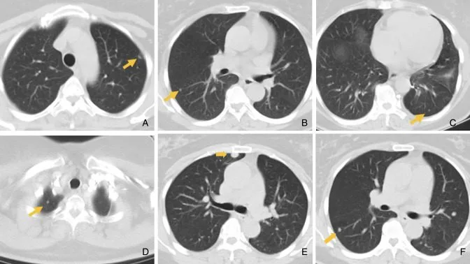 A patient, who was diagnosed with Lung Adenocarcinoma