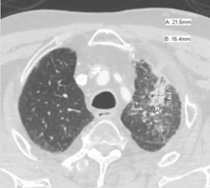 A patient, who was diagnosed with Lung Adenocarcinoma