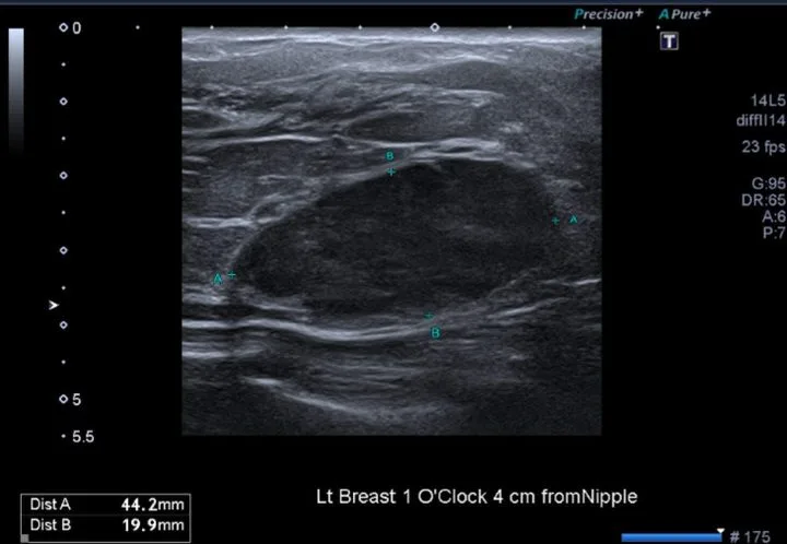 A patient, who was diagnosed with Invasive Ductal Carcinoma