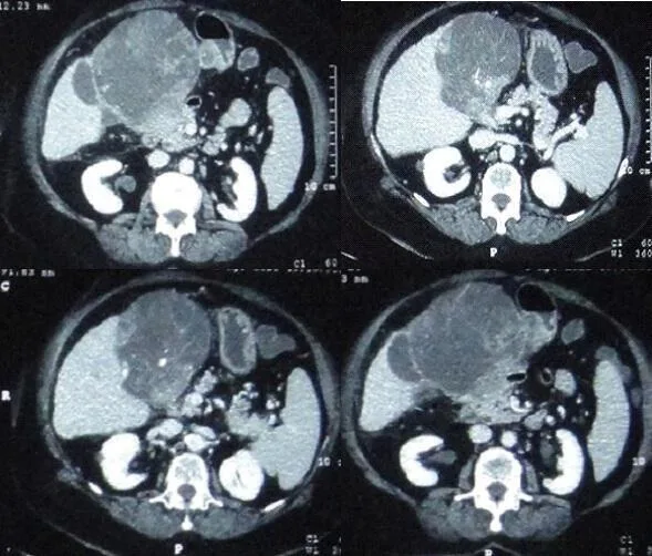 A patient, who was diagnosed with Gastric Cancer