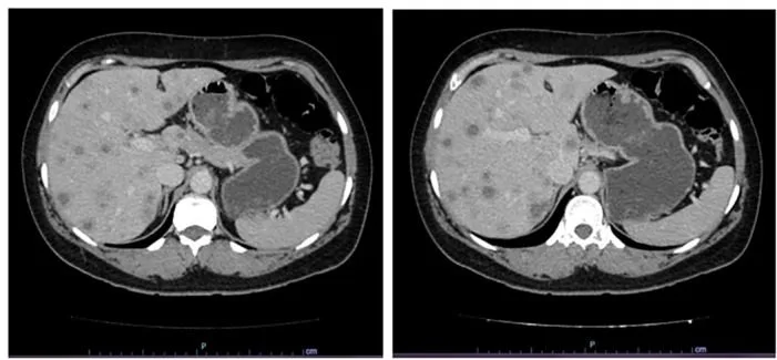 A patient, who was diagnosed with Stage IV Breast Cancer