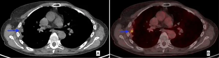 A patient, who was diagnosed with Stage IV Invasive Ductal Carcinoma