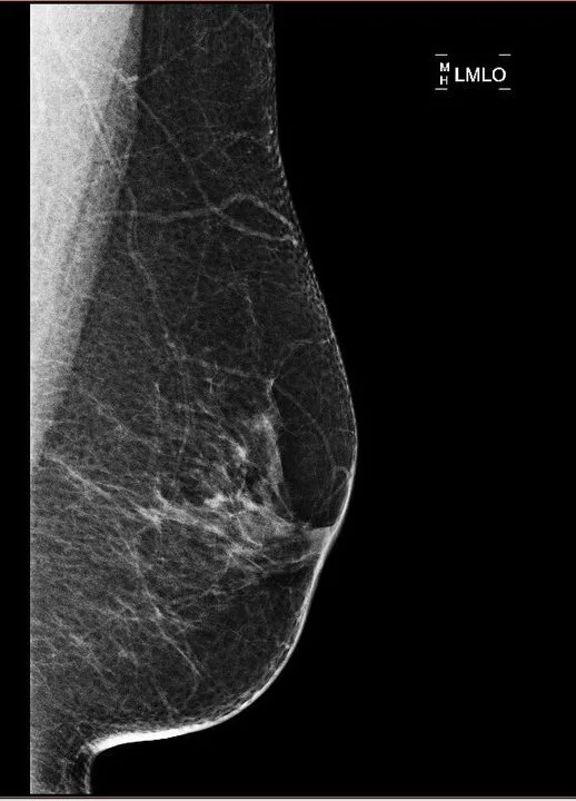 A patient, who was diagnosed with Stage IV Invasive Ductal Carcinoma