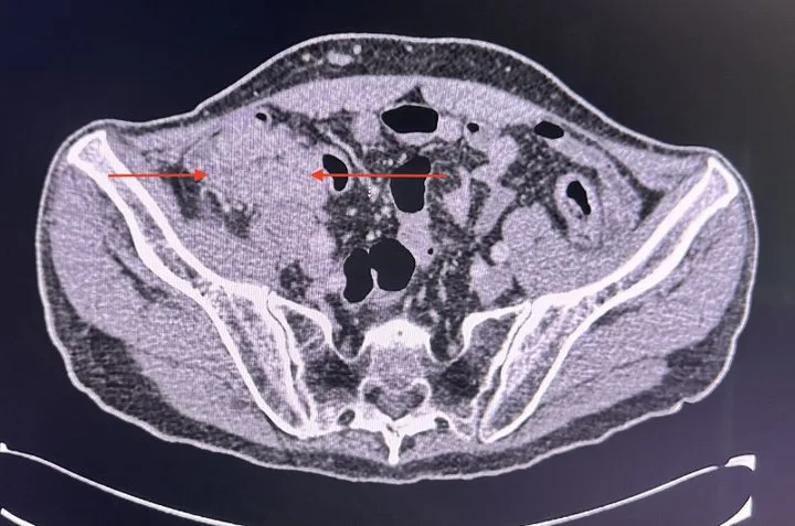 A patient, who was diagnosed with Colorectal Adenocarcinoma