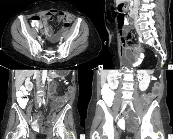 A patient, who was diagnosed with Stage IV Colorectal Adenocarcinoma