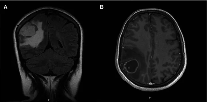 A patient, who was diagnosed with Non-Small Cell Lung Cancer