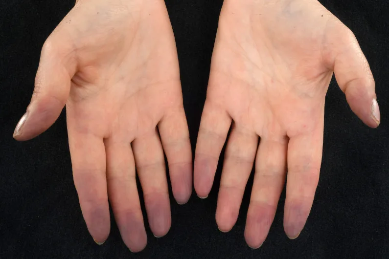 A patient, who was diagnosed with Ovarian Cancer
