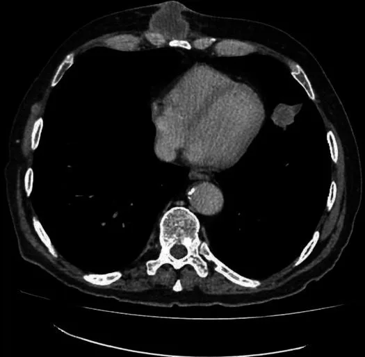 A patient, who was diagnosed with Stage IV Lung Cancer