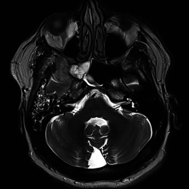 A patient, who was diagnosed with Stage IV Lung Adenocarcinoma