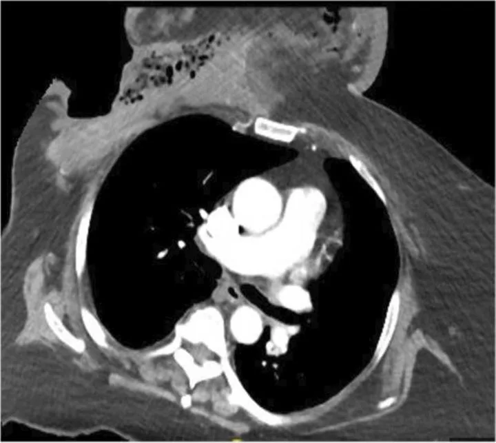 A patient, who was diagnosed with Breast Cancer