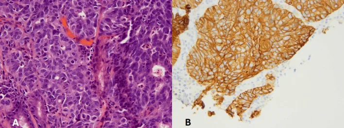 A patient, who was diagnosed with Gastric Adenocarcinoma