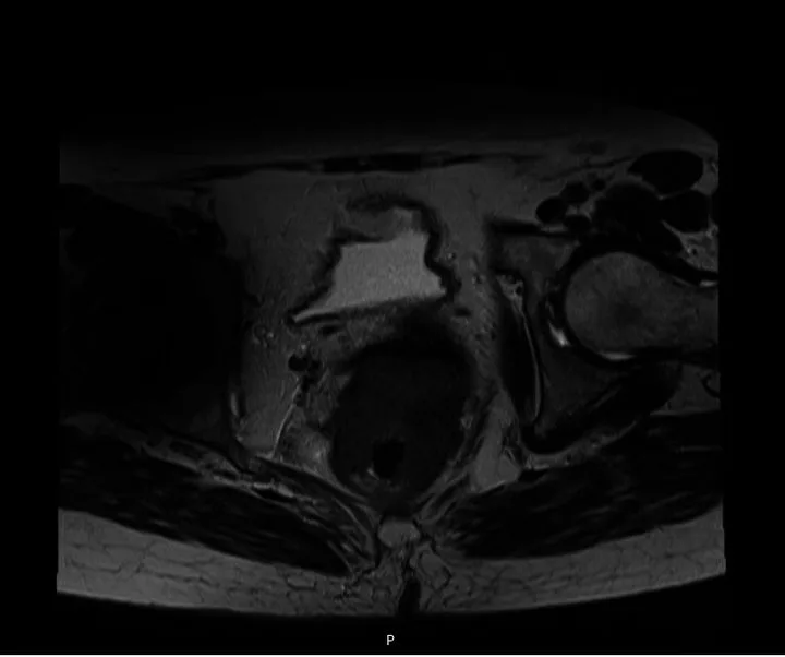 A patient, who was diagnosed with Colorectal Squamous Cell Carcinoma