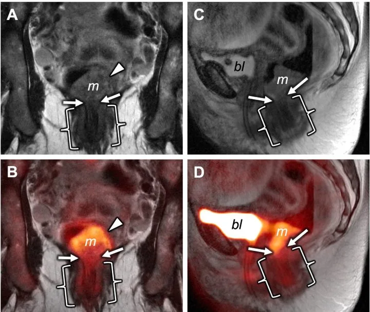 A patient, who was diagnosed with Stage IV Colorectal Squamous Cell Carcinoma