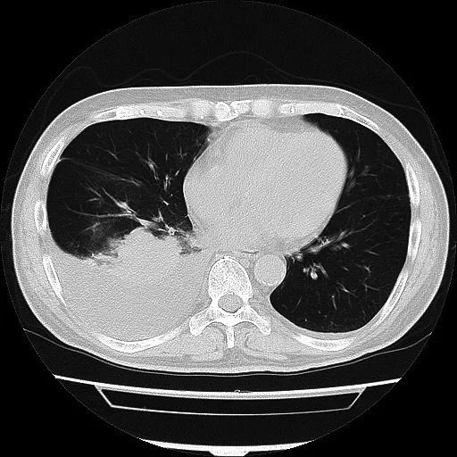 A patient, who was diagnosed with Non-Small Cell Lung Cancer